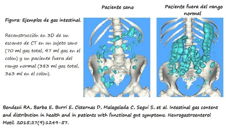 Volumen y distribución del gas intestinal en sujetos sanos (izda) y con trastornos gastrointestinales funcionales crónicos (drcha)
