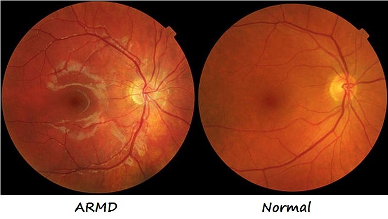 Izda: ARMD.  Drcha:  Macula sana
