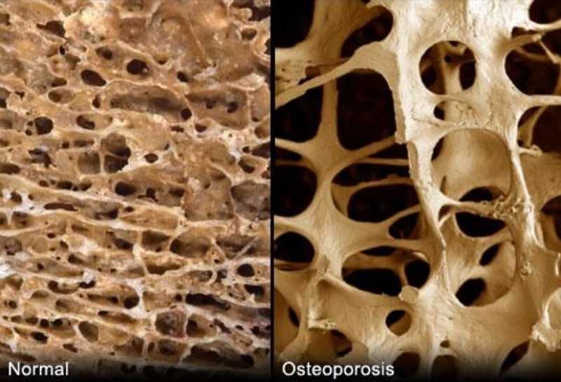 Izda: Imagen de hueso sano. Drcha: Imagen de hueso osteoporótico
