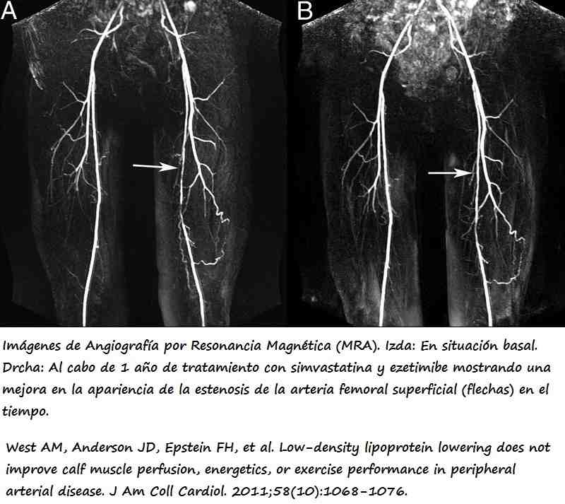 Imagenes de las extremidades inferiores de un paciente con PAD antes y después de intervención farmacológica
