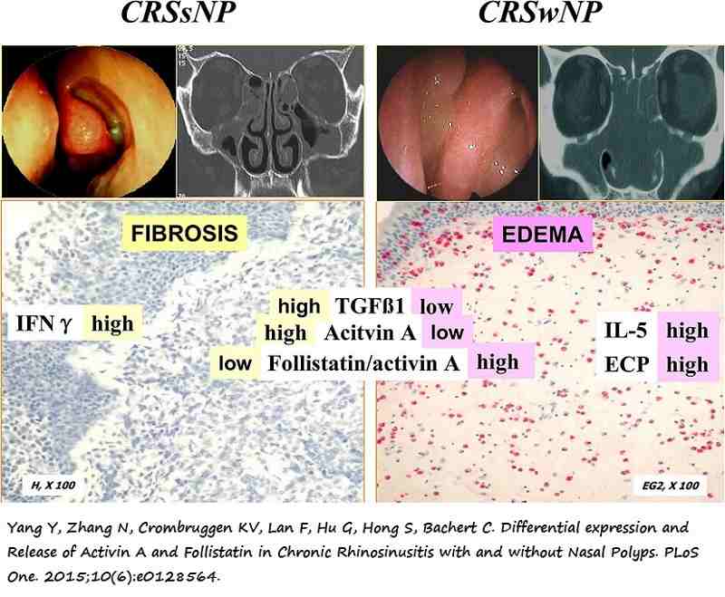 Patrón remodelado CRSsNP versus CRSwNP