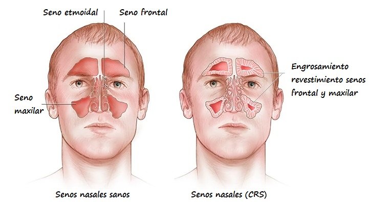 Imagen frontal (izda: senos nasales sanos y drcha: senos nasales CRS)