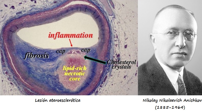 N. N. Anichkov y la relación colesterol-ateroesclerosis Izda: Lesión ateroesclerótica. Drcha: N. N. Anichkov