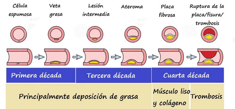 Progresión de la ateroesclerosis Estadios de la lesión ateroesclerórica