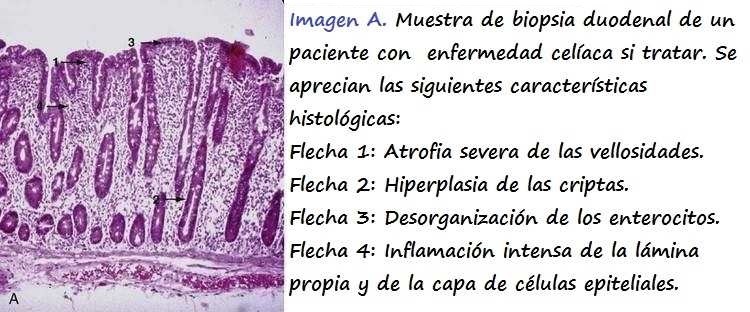 Mucosa duodenal de un paciente con enfermedad celiaca sin tratar. 