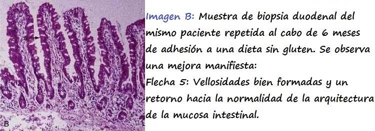Mucosa duodenal de un paciente con enfermedad celiaca tras seguir una dieta sin gluten