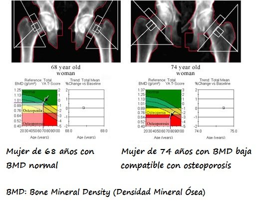 Izda: Imagen DXA de mujer de 68 años con BMD normal. Drcha: Imagen DXA de mujer de 74 años con BMD compatible con osteoporosis