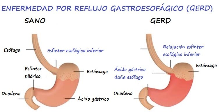 Estudio sobre la tasa de uso de consejos relacionados con los cambios en  los estilos de vida en pacientes con GERD en clínicas médicas