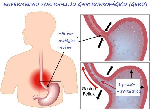 Alteraciones fisiológicas del tracto gastrointestinal en sujetos con GERD. Izda: Dibujo de torso humano y del esófago, unidos por el esfínter esofágico inferior. Drcha: Ampliación de dichas regiones anatómicas
