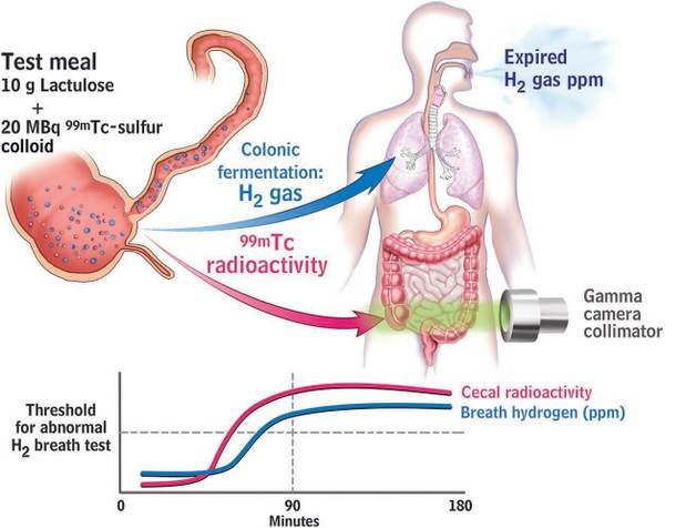 Arriba: Dibujo de anatomía de ser humano y fisiología de la fermentación colónica. Abajo: Gráfica del hidrógeno expirado 