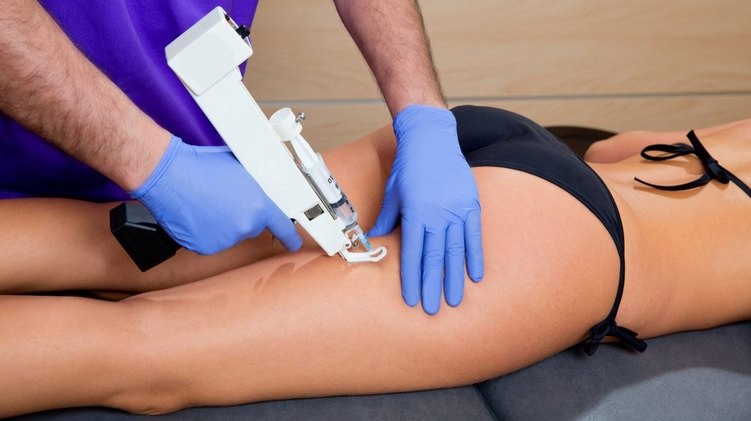 Administración de una inyección de mesoterapia a una mujer