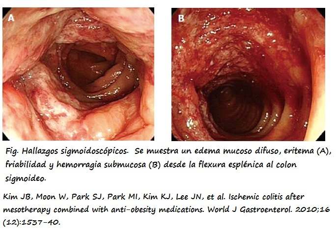 Colitis isquémica en paciente sometida a tratamiento de mesoterapia y fármacos antiobesidad