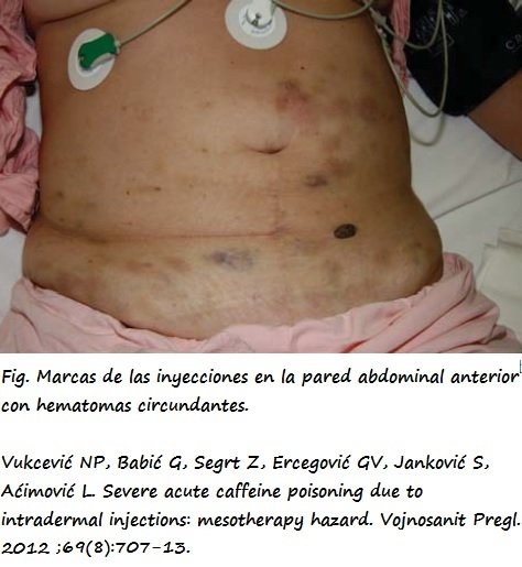 Envenenamiento por infiltración de cafeína en un tratamiento de mesoterapia
