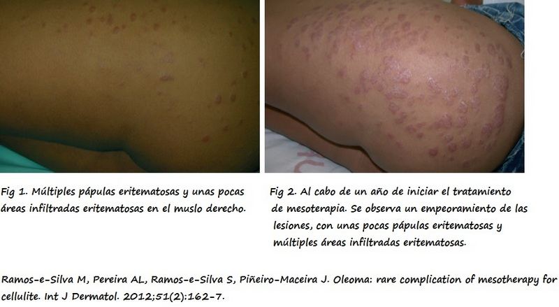Oleoma en mujer sometida a mesoterapia