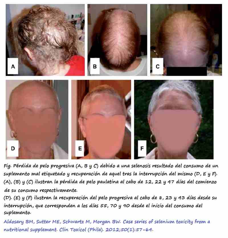 Pelo del paciente 5 tras el consumo de un suplemento con dosis suprafisiológicas de Se