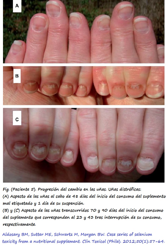 Uñas del paciente 5 tras el consumo de un suplemento con dosis suprafisiológicas de Se