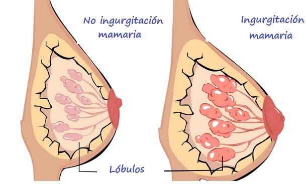 Izda: No ingurgitación mamaria. Drcha: Ingurgitación mamaria