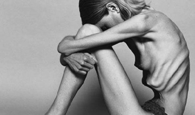 Perfil izdo de una chica con Anorexia Nerviosa