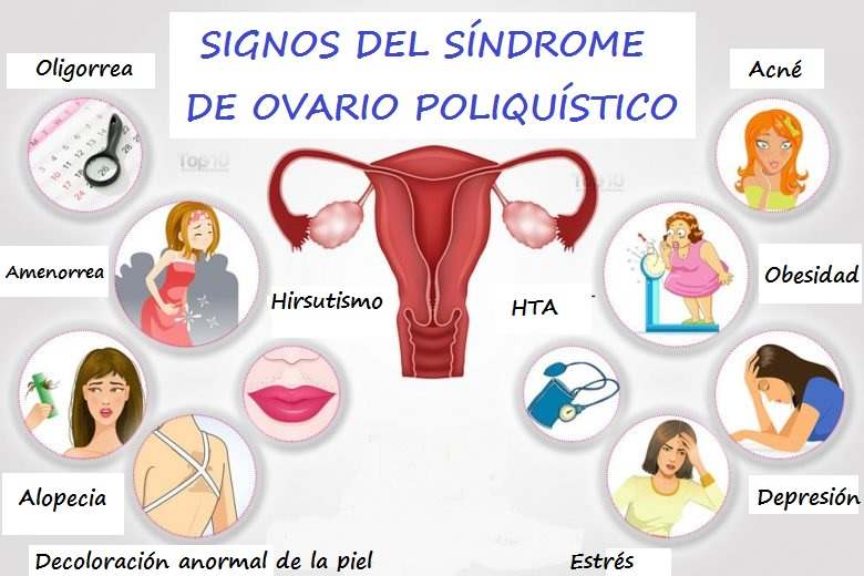 Signos del Síndrome de Ovario Poliquístico