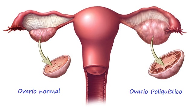 Dibujo de la perspectiva frontal de un ovario normal y poliquístico