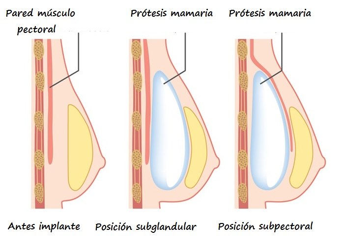 Tipos de intervenciones de cirugía mamaria