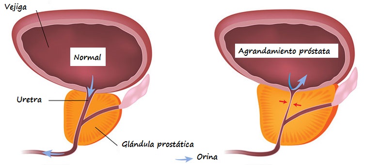 Izda: Próstata de un varón sano. Drcha. Próstata de un varón con HPB