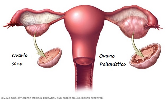 Dibujo de un dos ovarios. Izda: ovario sano. Drcha: Ovario poliquístico.