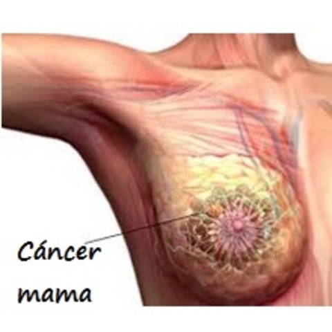 Cáncer de mama: Clasificación según subtipos moleculares