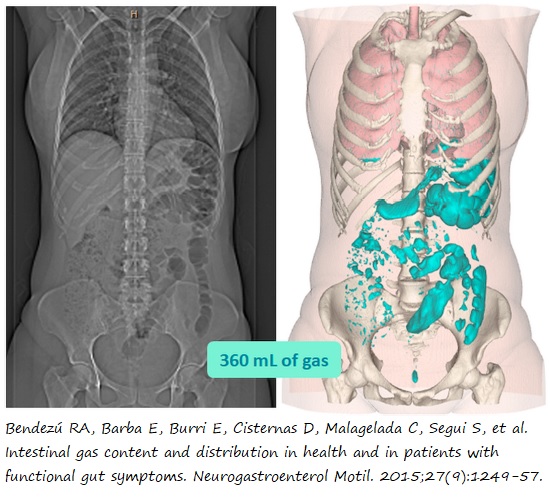 Volumen y distribución de gas intestinal en sujetos sanos versus con hinchazón y/o distensión  funcional crónica: Estudio de Bendezú RA et al.