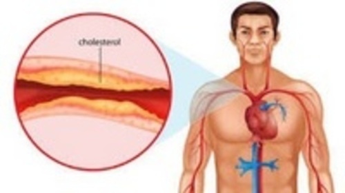 ¿Qué es la hipótesis lipídica de la enfermedad cardiovascular?