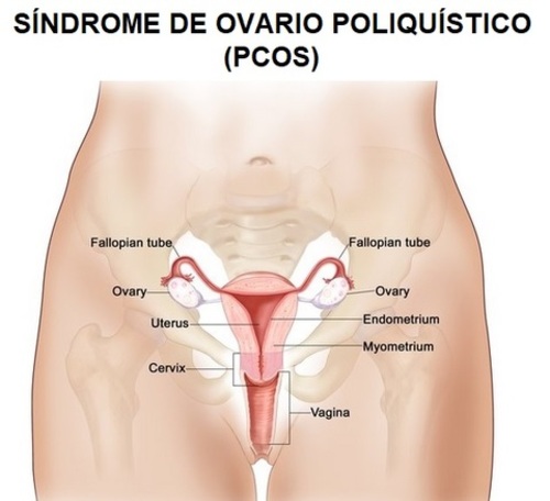 Síndrome de Ovario Poliquístico (PCOS) 