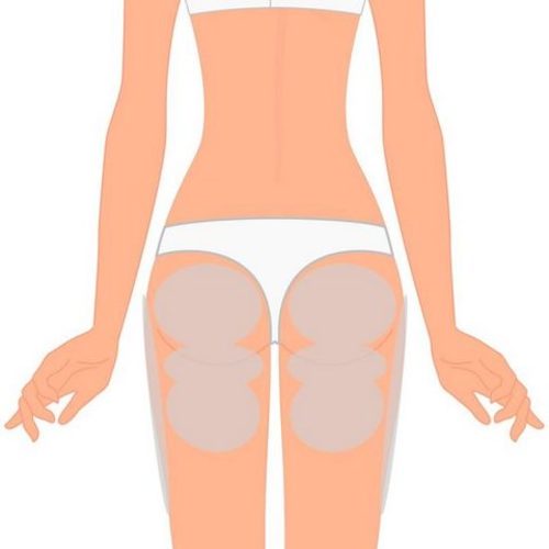 Efectos secundarios de la mesoterapia en el tratamiento de la obesidad y la celulitis