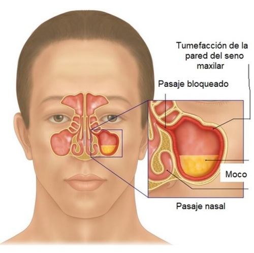 Rinosinusitis Crónica (CRS)